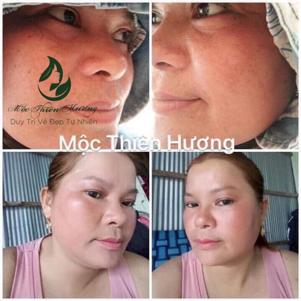 Combo Dành Cho Da Nám, Dưỡng Trắng Da Cấp Tốc Mộc Thiên Hương | BigBuy360 - bigbuy360.vn