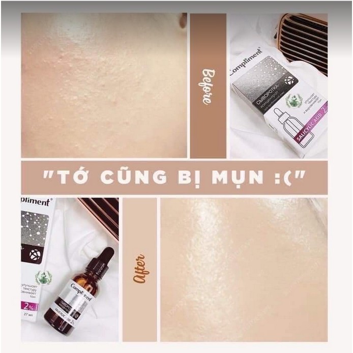 Serum Compliment 2% BHA làm sạch sâu, giảm mụn, se lỗ chân lông, kiềm dầu | BigBuy360 - bigbuy360.vn