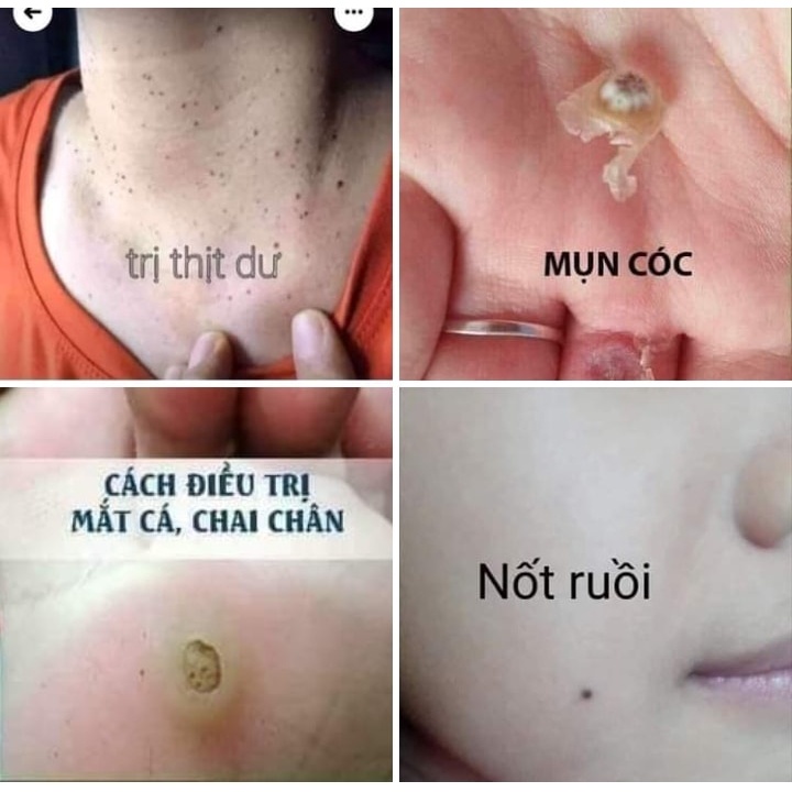 6 Miếng dán tẩy mụn cóc, mụn nhọt vết chai, mắt cá chân