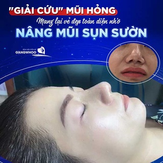 Dịch vụ nâng mũi sụn sườn tại Gangwhoo