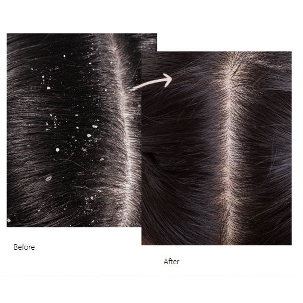 Tẩy da chết JIORNIEE tẩy tế bào chết da đầu - kiểm soát dầu nhờn giảm bết tóc làm sạch gàu