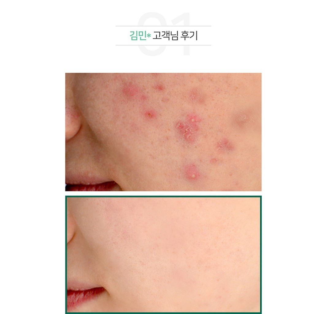 Serum Giảm Mụn Some By Mi AHA-BHA-PHA 30 Days Miracle 50ml