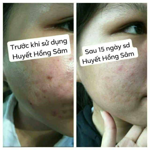 HUYẾT HỒNG SÂM - VUA TRỊ MỤN - TÁI TẠO | BigBuy360 - bigbuy360.vn