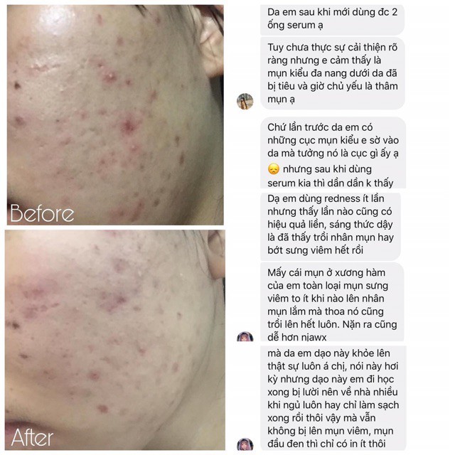 Serum gảm mụn cấp tốc TEANA SUPER PEPTIDES NO PROBLEM INTENSIVE, sản phẩm không thể thiếu trong quá trình đẩy mụn | BigBuy360 - bigbuy360.vn
