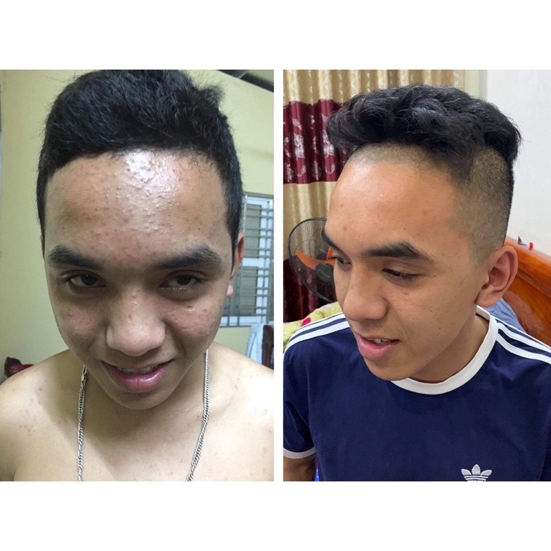 Serum mụn Nhà Bơ