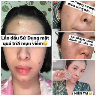 Cao mụn sâm đỏ