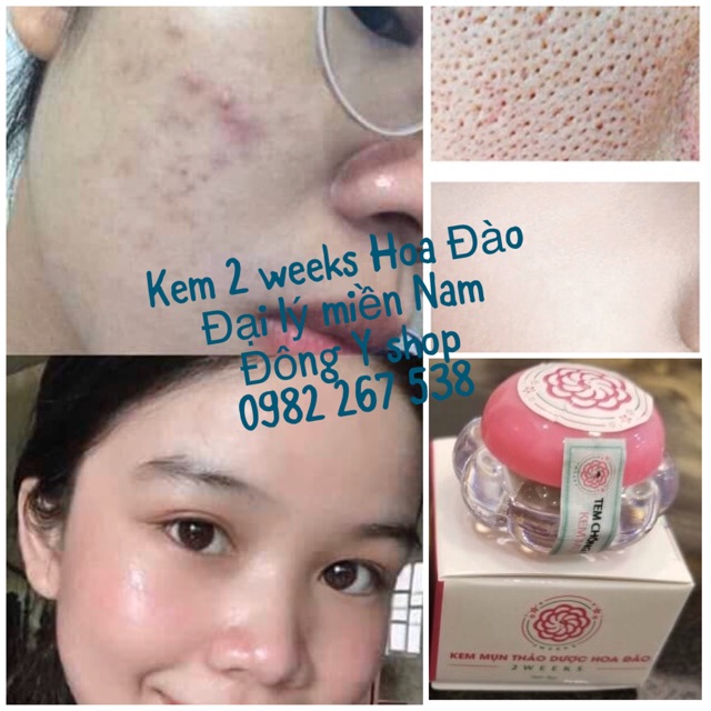 Kem Mụn Hoa Đào 2 weeks Vượng Xuân Đường