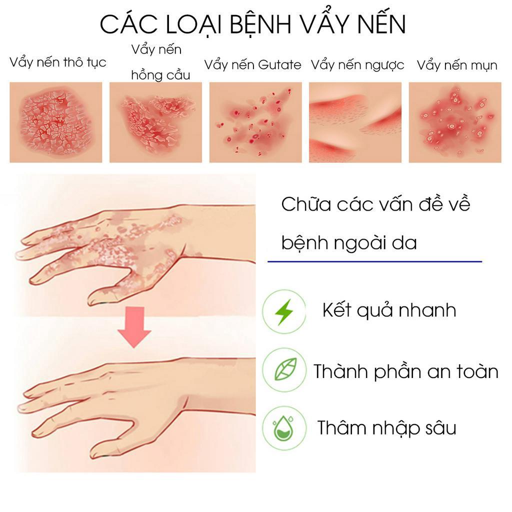 Kem bôi vẩy nến, viêm da kháng khuẩn đánh bay nấm da, chống ngứa viêm da, hắc lào, lang ben, mề đay, viêm da cơ địa, á sừng, vảy nến, tổ đỉa, viêm da dầu, viêm da dị ứng