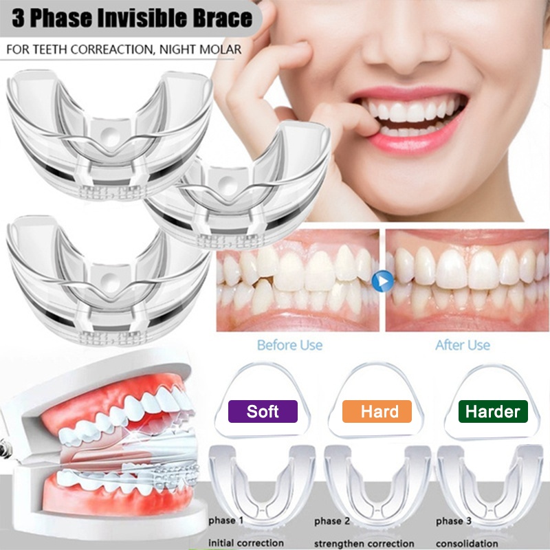 Niềng bọc răng trong suốt chỉnh hình chuyên dụng thích hợp cho người lớn sử dụng tại nhà