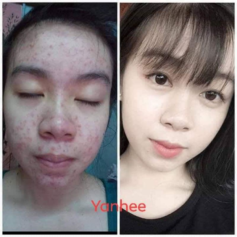 Xà Phòng ngừa mụn Thái Lan