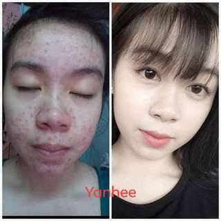 Xà Phòng ngừa mụn Thái Lan