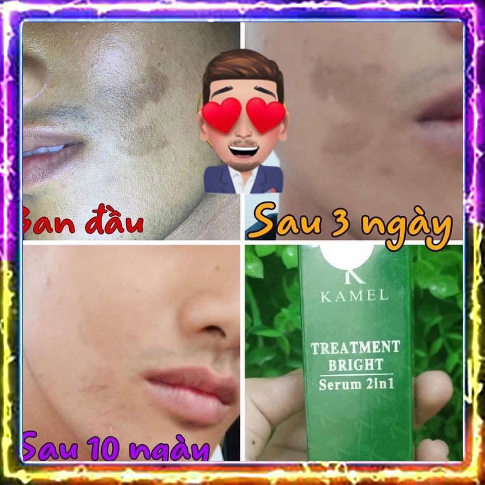 [Sẵn hàng] Treatment Bright Serum 2in1 loại bỏ thâm làm căng bóng trắng da Kamel lọ 10ml | BigBuy360 - bigbuy360.vn