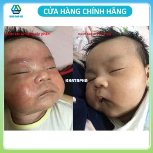 Kutieskin 30gr giành cho da em bé bị chàm , lác sữa