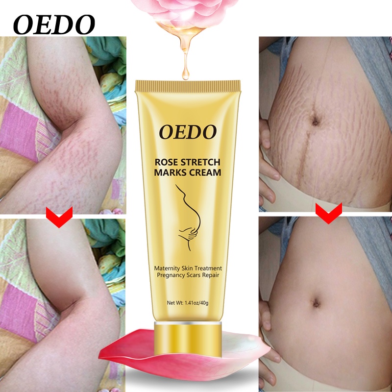 Kem Hoa Hồng OEDO Trị Vết Rạn Da/Lão Hóa/Chống Lão Hóa Cho Phụ Nữ Mang Thai