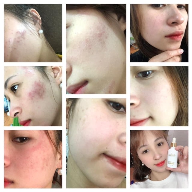 Serum Detox Acnes For Skin Ngăn Ngừa Mụn Doctor Queen