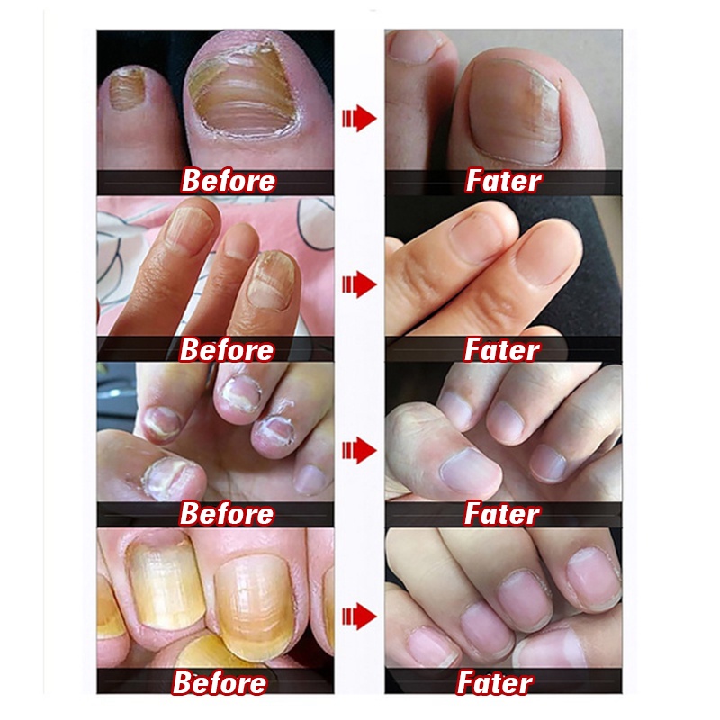 Tinh Chất Hỗ Trợ Giảm Bệnh Nấm Móng Chăm Sóc Móng Tay Tiện Dụng