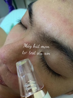 Máy hút mụn cầm tay
