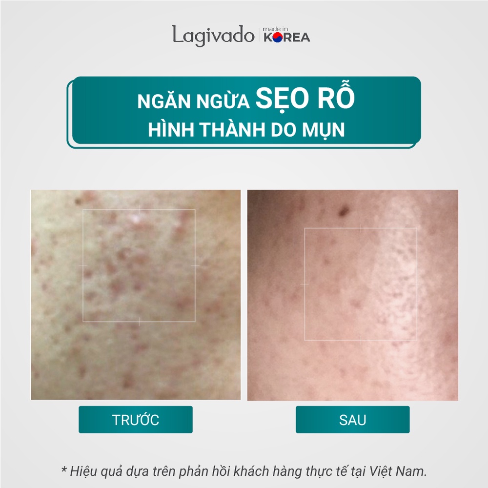 ATREAT CREAM LAGIVADO - Kem giảm mụn, ngăn ngừa thâm sẹo Hydrolyzed sponge 2% 30g