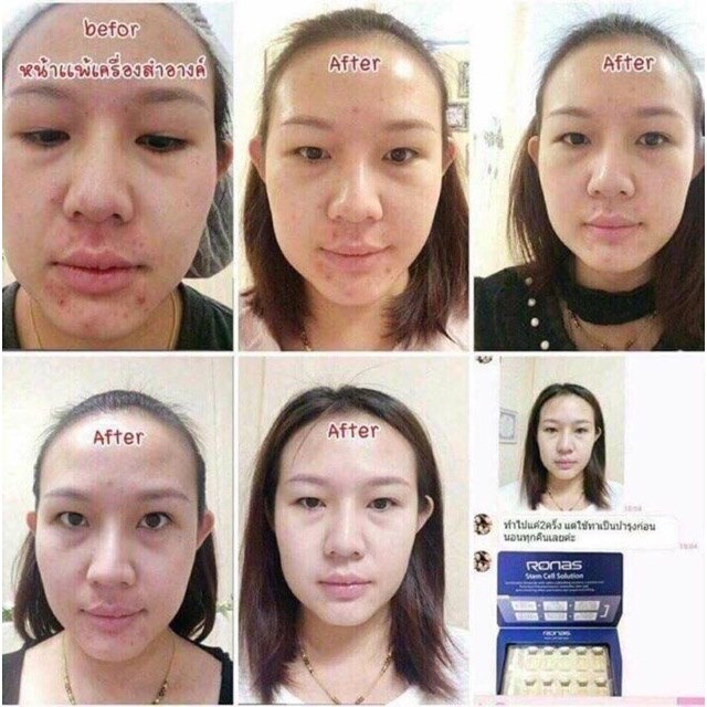 Tế Bào Gốc Ronas Stem Cell Solution [Chuẩn] - Sau Lăn kim - Phi kim - Peel Da - Mờ Sẹo - Thâm - Làm Trắng Da- Căng mịn