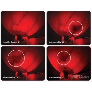 Máy soi ngực cá nhân Breast Scan BREMED BD2200