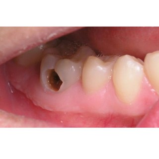 Nước ngậm súc miệng