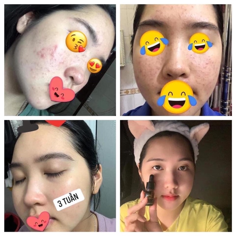 SERUM KHỔ QUA nguyên chất giảm mụn sáng da mờ vết thâm se khít lỗ chân lông giúp da sáng đều màu | BigBuy360 - bigbuy360.vn