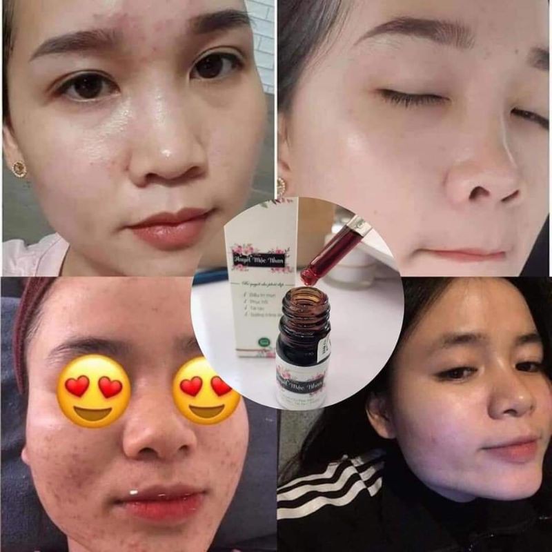 Thảo mộc ngăn ngừa mụn | BigBuy360 - bigbuy360.vn