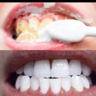 KEM TRẮNG RĂNG THAN HOẠT TÍNH