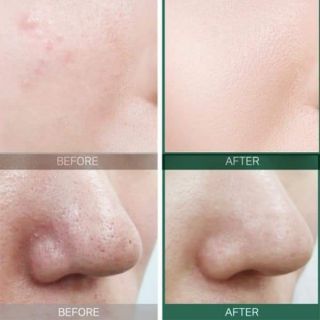 Nước hoa hồng trị thâm mụn Some by me