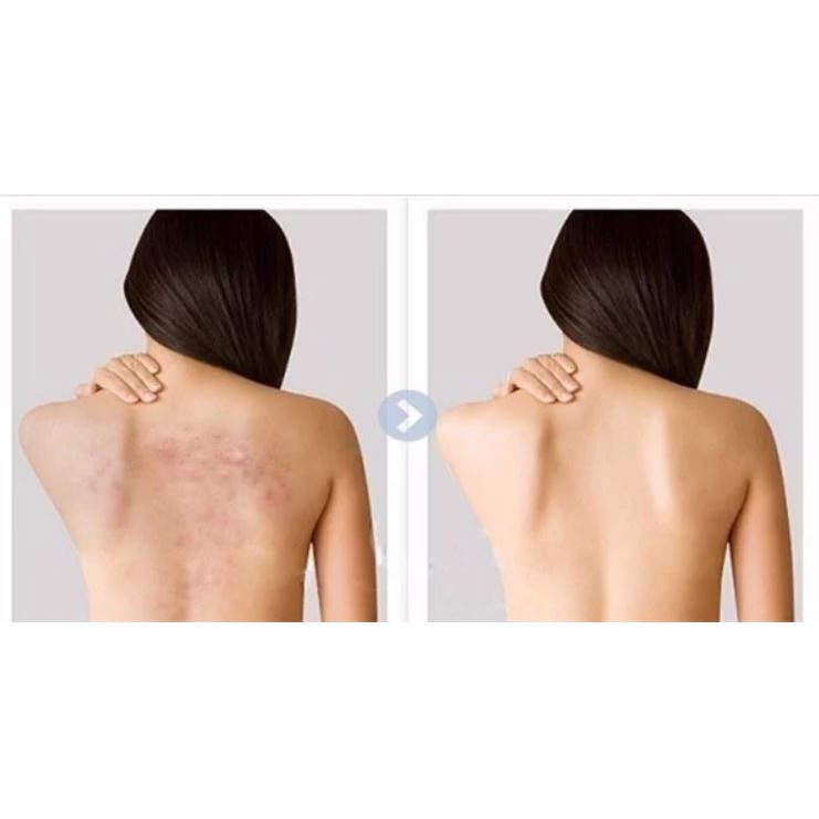 Xịt Mụn Lưng For Back Medicated Spray