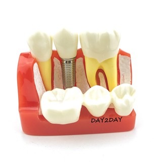Mô hình tư vấn nha khoa, so sánh implant và cầu răng - Mẫu hàm 2017