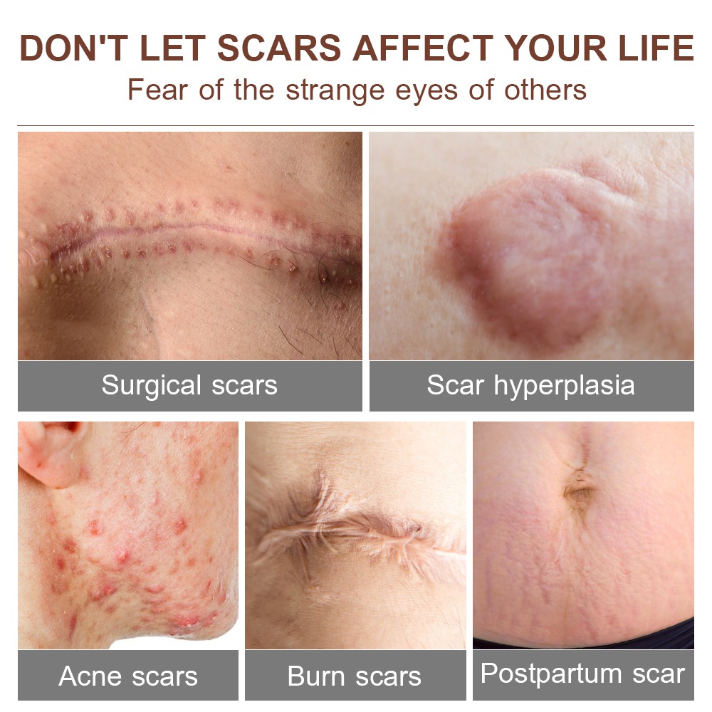 Serum Xóa Sẹo Mụn VIBRANT GLAMOUR Giảm Đốm Loại Bỏ Vết Rạn/Nếp Nhăn Làm Trắng Thu Nhỏ Lỗ Chân Lông 15ml | BigBuy360 - bigbuy360.vn