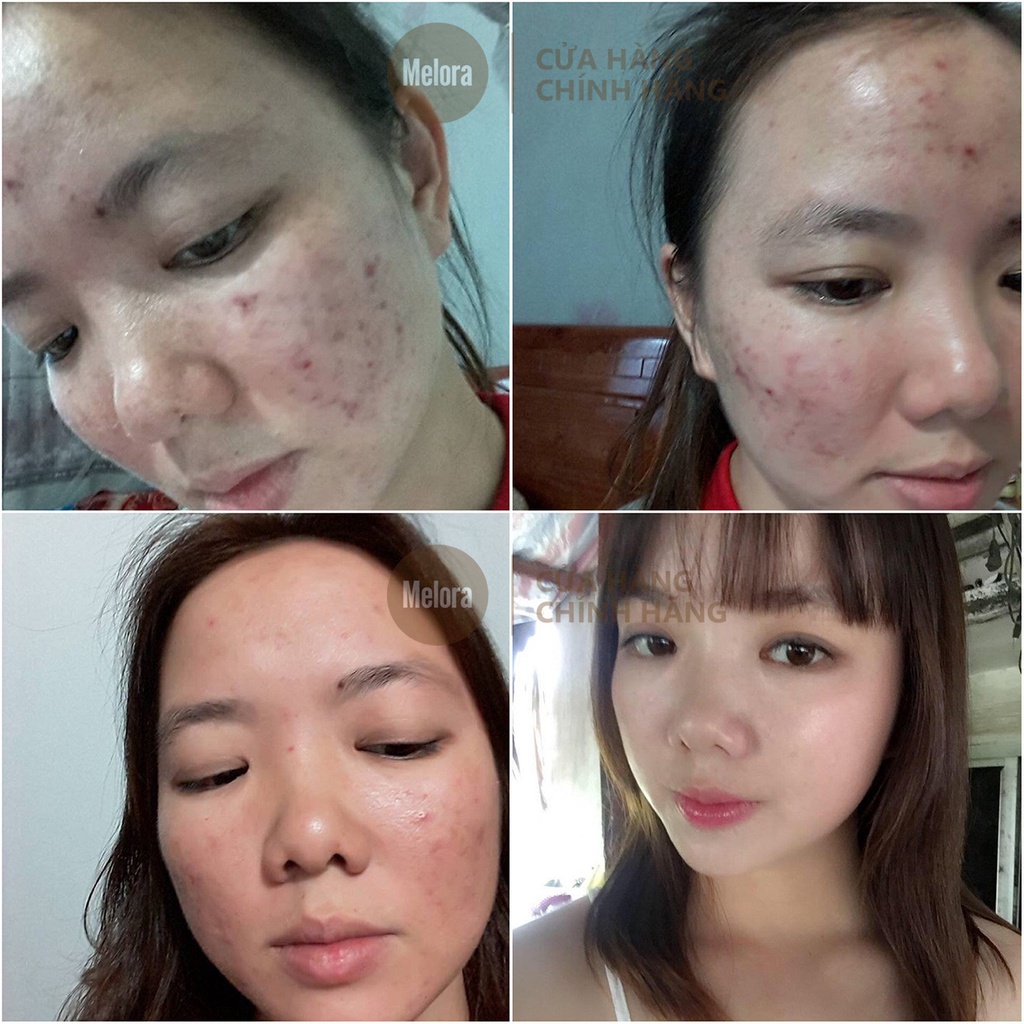 Tinh Chất Chấm Mụn Mờ Thâm Chính Hãng Cafuné Essence 15ml thành phần AHA Và Tràm Trà - Giảm Mụn, Giảm Thâm, Dưỡng Da