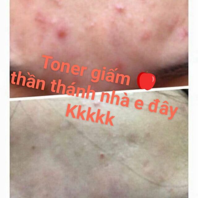 Toner giấm táo