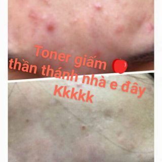 Toner giấm táo