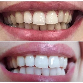 Miếng dán trắng răng oralb