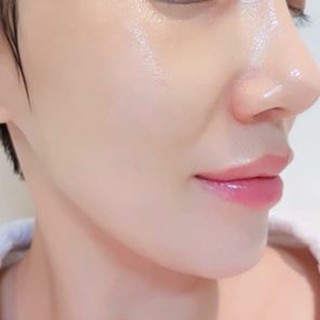 [Tách sét] Chỉ Tơ Căng Da Tự Tiêu CHITOSSIL Thread Lift Ampoule 521