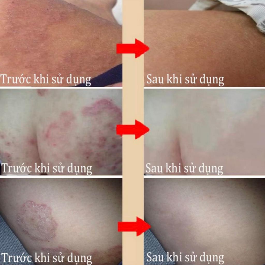 Xịt áp lạnh balanitis hỗ trợ loại bỏ sùi mào gà, gai sinh duc, hạt ngọc dv sau một tuần sử dụng ( có che tên sp )