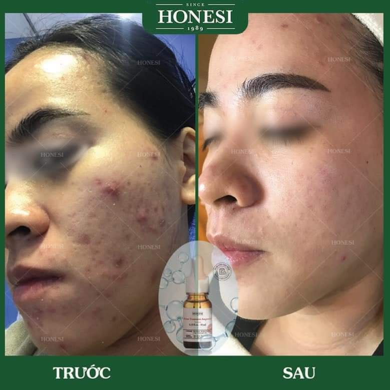 Tinh Chất Giảm Mụn Honesi Acne Treatment Anpoule