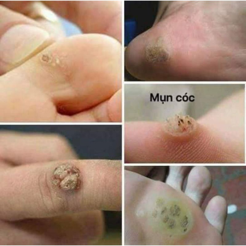 hỗ trợ tẩy mụn ruồi, Mụn cóc,mụn cơm, mắt cá chân vết chai sành | BigBuy360 - bigbuy360.vn