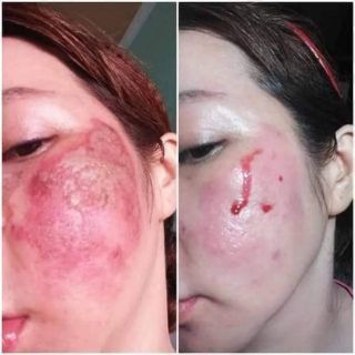 Tế bào thực vật siêu phục hồi da