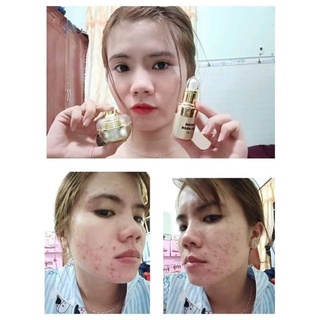 [ Kèm quà] Combo chuyên mụn Huỳnh Đỗ, sạch mụn hết thâm
