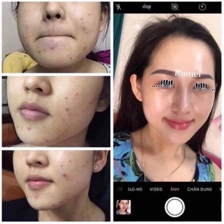 Serum Mụn Detox Acnes Kamel 10ml