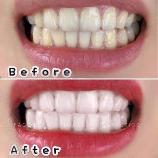 Miếng dán trắng răng Cresst 3D White Mỹ