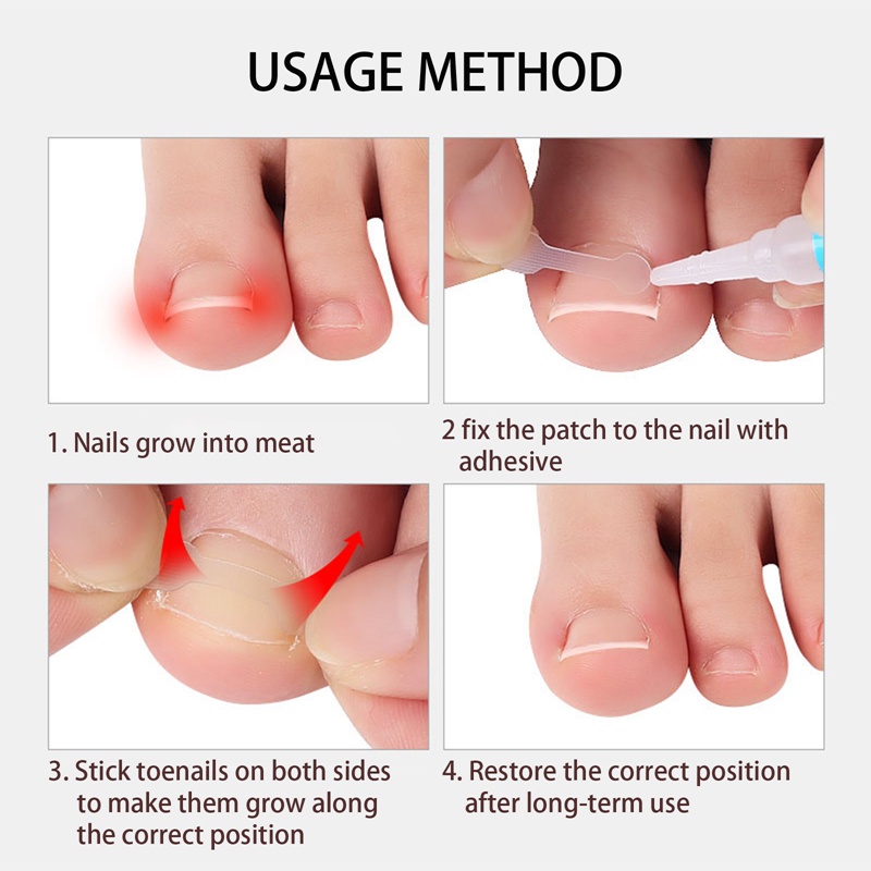 Hộp 10 Miếng Dán Điều Chỉnh Móng Chân Tiện Lợi