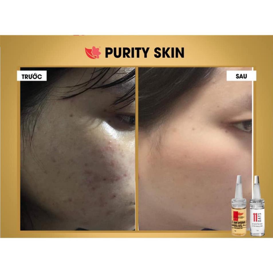 Serum giảm mụn giảm thâm Purity Skin Linh Hương - ngăn ngừa giảm mụn trứng cá, mụn bọc, dưỡng da hồi phục da mụn | BigBuy360 - bigbuy360.vn
