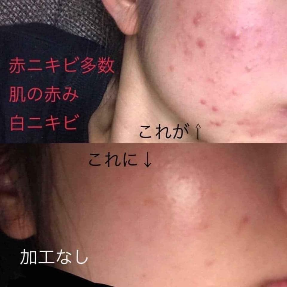 Tuýp DALACIN T 1% 10g đánh bay mụn - tách lẻ 1 tuýp