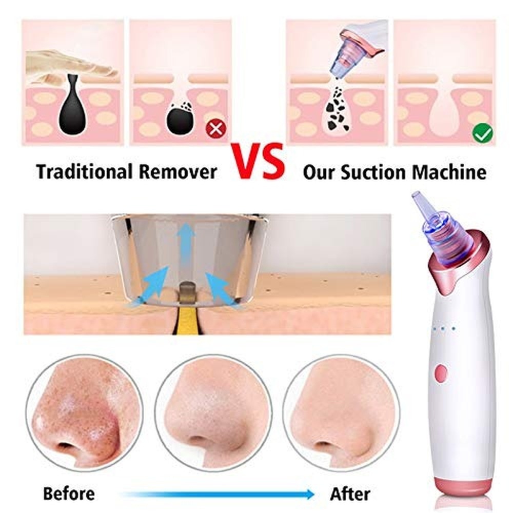 Máy hút mụn đầu đen Suolaer chăm sóc da mặt tiện lợi