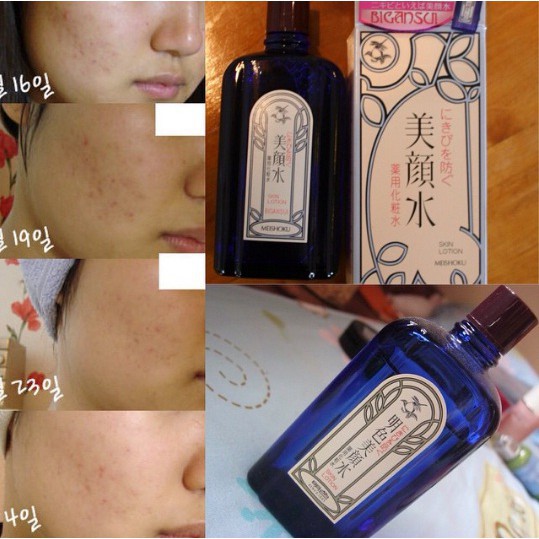 Lotion Giảm Mụn Meishoku Bigansui Medicated Nhật - Hàng Chính Hãng