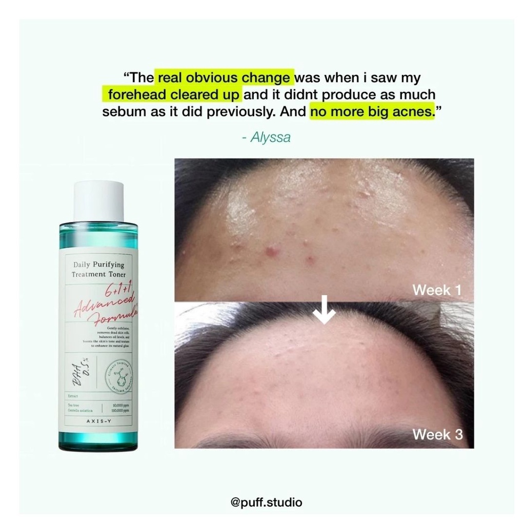 Nước Hoa Hồng Làm Giảm Mụn AXIS-Y Daily Purifying Treatment Toner